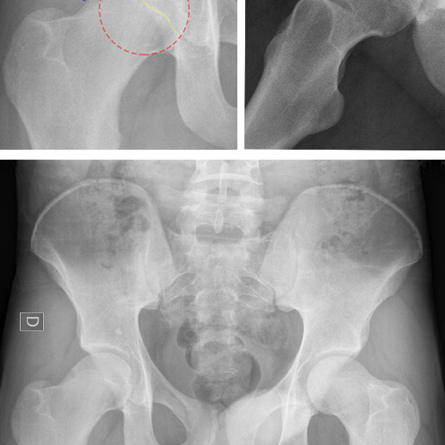 Potter's Test for hip impingement (PHIT: Potter Hip Impingement Test) Podcast Cover Image